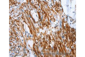 Immunohistochemistry of Human cervical cancer using SHROOM2 Polyclonal Antibody at dilution of 1:50