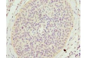 Immunohistochemistry of paraffin-embedded human cervical cancer using ABIN7158965 at dilution of 1:100 (Mammaglobin A anticorps  (AA 1-93))