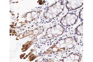 ABIN6267473 at 1/200 staining human colon cancer tissue sections by IHC-P. (AKT1 anticorps  (pThr308))