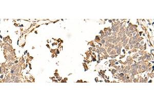 Immunohistochemistry of paraffin-embedded Human lung cancer tissue using SOX3 Polyclonal Antibody at dilution of 1:50(x200) (SOX3 anticorps)