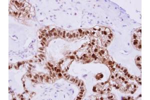 IHC-P Image DNAJB2 antibody detects DNAJB2 protein at cytosol on human ovarian Carcinoma by immunohistochemical analysis.