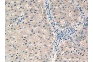 IHC-P analysis of Human Liver Cancer Tissue, with DAB staining. (Retinol Binding Protein 5 anticorps  (AA 2-135))