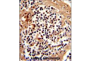 Formalin-fixed and paraffin-embedded human kidney carcinoma reacted with SERPINB7 Antibody , which was peroxidase-conjugated to the secondary antibody, followed by DAB staining. (SERPINB7 anticorps  (AA 108-137))
