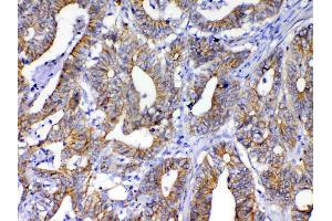 IHC analysis of beta Catenin using anti-beta Catenin antibody .