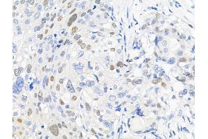 Phospho-KDM3A (Tyr1114) Antibody at 1/100 staining Human ovarian cancer by IHC-P.