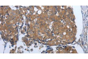 Immunohistochemistry of paraffin-embedded Human breast cancer tissue using PDIA2 Polyclonal Antibody at dilution 1:50 (PDIA2 anticorps)