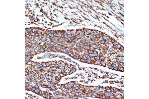 Immunohistochemistry of paraffin-embedded human esophageal cancer using NDUFB8 Rabbit mAb (ABIN7268813) at dilution of 1:100 (40x lens).