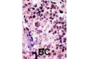 Formalin-fixed and paraffin-embedded human cancer tissue reacted with PRKAR1B polyclonal antibody  , which was peroxidase-conjugated to the secondary antibody, followed by AEC staining. (PRKAR1B anticorps  (N-Term))