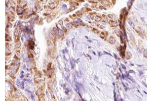 ABIN6267637 at 1/100 staining human Thyroid cancer tissue sections by IHC-P. (BIK anticorps  (pThr33))