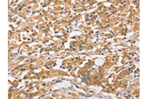 The image on the left is immunohistochemistry of paraffin-embedded Human thyroid cancer tissue using ABIN7128517(ARL8A Antibody) at dilution 1/20, on the right is treated with fusion protein. (ARL8A anticorps)