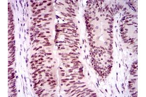 Immunohistochemical analysis of paraffin-embedded colon cancer tissues using TP53BP1 mouse mAb with DAB staining.