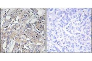 Immunohistochemistry analysis of paraffin-embedded human breast carcinoma tissue, using Collagen VI alpha3 Antibody. (COL6a3 anticorps  (AA 2261-2310))