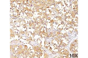 IHC staining of human melanoma (10X) with gp100 antibody (HMB45). (Melanoma gp100 anticorps)