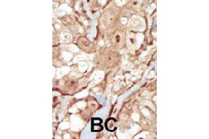 Formalin-fixed and paraffin-embedded human cancer tissue reacted with PDGFRB polyclonal antibody  , which was peroxidase-conjugated to the secondary antibody, followed by AEC staining. (PDGFRB anticorps  (N-Term))