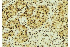 ABIN6276504 at 1/100 staining Human breast cancer tissue by IHC-P. (MAGED1 anticorps  (Internal Region))
