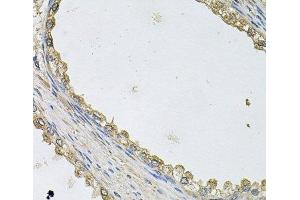 Immunohistochemistry of paraffin-embedded Human prostate using MTERFD1 Polyclonal Antibody at dilution of 1:100 (40x lens). (MTERFD1 anticorps)