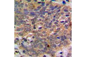 Immunohistochemical analysis of AKT (pS473) staining in human breast cancer formalin fixed paraffin embedded tissue section. (AKT1 anticorps  (C-Term, pSer473))