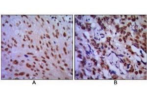 Immunohistochemical analysis of paraffin-embedded human lung cancer (A) and esophageal cancer (B), showing cytoplasmic localization using CDC2 antibody with DAB staining. (CDK1 anticorps)