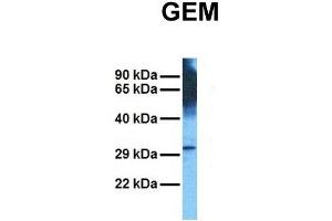 Host:  Rabbit  Target Name:  GEM  Sample Tissue:  Human Stomach Tumor  Antibody Dilution:  1.