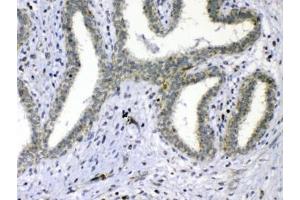 IHC testing of FFPE human breast cancer tissue with Cdc20 antibody at 1ug/ml. (CDC20 anticorps)