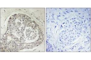 Immunohistochemistry analysis of paraffin-embedded human breast carcinoma, using K0100 Antibody.