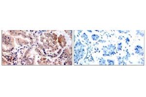 Immunohistochemical analysis of paraffin-embedded human lung carcinoma tissue, using AMPK1 (Ab-174) antibody (E021191). (PRKAA1 anticorps)