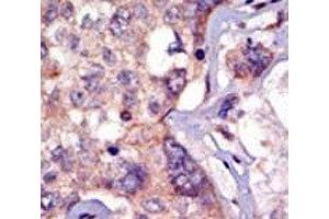 IHC analysis of FFPE human breast carcinoma tissue stained with the LCK antibody