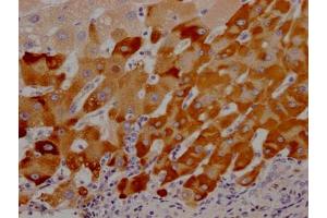 IHC image of ABIN7127603 diluted at 1:100 and staining in paraffin-embedded human liver cancer performed on a Leica BondTM system.