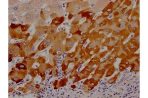 IHC image of ABIN7127603 diluted at 1:100 and staining in paraffin-embedded human liver cancer performed on a Leica BondTM system. (Recombinant LRG1 anticorps)