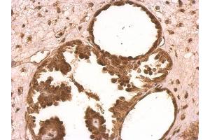 IHC-P Image XLF antibody [N3C3] detects XLF protein on human ovarian carcinoma by immunohistochemical analysis. (NHEJ1 anticorps)