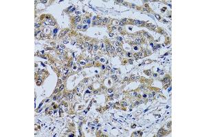 Immunohistochemistry of paraffin-embedded human colon carcinoma using TPPP3 antibody (ABIN2560511) at dilution of 1:100 (40x lens). (TPPP3 anticorps)