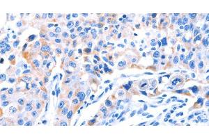 Immunohistochemistry of paraffin-embedded Human lung cancer tissue using SMG8 Polyclonal Antibody at dilution 1:50 (SMG8 anticorps)