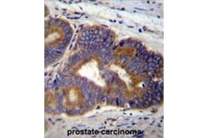 Formalin fixed, paraffin embedded human prostate carcinoma stained with YI016 Antibody (C-term) followed by peroxidase conjugation of the secondary antibody and DAB staining. (YI016 (AA 260-288), (C-Term) anticorps)