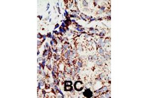 Formalin-fixed and paraffin-embedded human cancer tissue reacted with BAP1 polyclonal antibody  , which was peroxidase-conjugated to the secondary antibody, followed by DAB staining. (BAP1 anticorps  (N-Term))