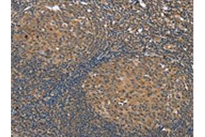 The image on the left is immunohistochemistry of paraffin-embedded Human tonsil tissue using ABIN7191184(KCNJ15 Antibody) at dilution 1/35, on the right is treated with synthetic peptide.