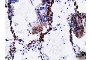 Immunohistochemical staining of paraffin-embedded Adenocarcinoma of Human breast tissue using anti-EPHX2 mouse monoclonal antibody. (EPHX2 anticorps)
