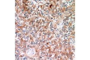 Immunohistochemical analysis of TRP2 staining in human breast cancer formalin fixed paraffin embedded tissue section. (DCT anticorps)