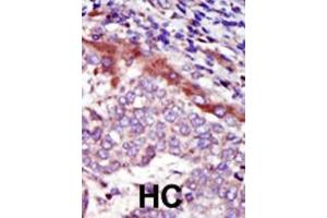 Formalin-fixed and paraffin-embedded human cancer tissue reacted with the primary antibody, which was peroxidase-conjugated to the secondary antibody, followed by AEC staining. (HUNK anticorps  (C-Term))