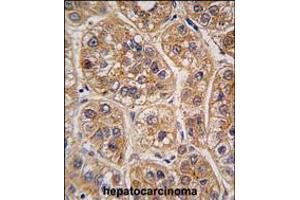Formalin-fixed and paraffin-embedded human hepatocarcinoma tissue reacted with AKR1A1 antibody , which was peroxidase-conjugated to the secondary antibody, followed by DAB staining. (AKR1A1 anticorps  (C-Term))