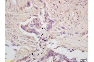 Formalin-fixed and paraffin embedded human colon carcinoma labeled with Rabbit Anti GPAM Polyclonal Antibody, Unconjugated (ABIN709121) at 1:200 followed by conjugation to the secondary antibody and DAB staining (GPAM anticorps  (AA 611-710))