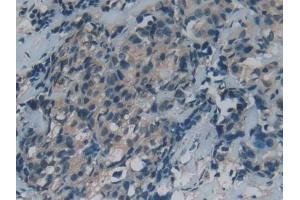 DAB staining on IHC-P; Samples: Human Thyroid cancer Tissue (GAS6 anticorps  (AA 136-311))