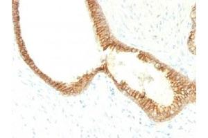 Formalin-fixed, paraffin-embedded human prostate carcinoma stained with E-Cadherin antibody (CDH1/1525).