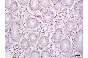 Formalin-fixed and paraffin embedded human gastric carcinoma labeled with Rabbit Anti BCL-6/5 Polyclonal Antibody, Unconjugated  at 1:200 followed by conjugation to the secondary antibody and DAB staining