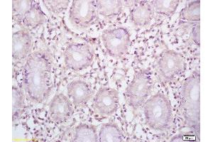 Formalin-fixed and paraffin embedded human gastric carcinoma labeled with Rabbit Anti BCL-6/5 Polyclonal Antibody, Unconjugated  at 1:200 followed by conjugation to the secondary antibody and DAB staining (BCL6 anticorps  (AA 501-600))
