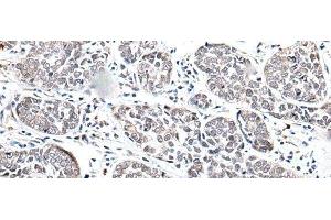 Immunohistochemistry of paraffin-embedded Human esophagus cancer tissue using BRMS1L Polyclonal Antibody at dilution of 1:45(x200)