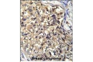 KLHL35 Antibody (C-term) (ABIN656072 and ABIN2845420) immunohistochemistry analysis in formalin fixed and paraffin embedded human breast carcinoma followed by peroxidase conjugation of the secondary antibody and DAB staining. (KLHL35 anticorps  (C-Term))
