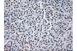 Immunohistochemical staining of paraffin-embedded Adenocarcinoma of breast tissue using anti-MRI1 mouse monoclonal antibody. (MRI1 anticorps)