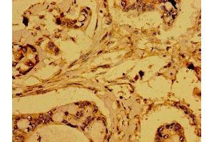 Immunohistochemistry of paraffin-embedded human pancreatic cancer using ABIN7168921 at dilution of 1:100 (HTRA2 anticorps  (AA 334-458))