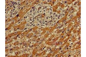 Immunohistochemistry of paraffin-embedded human liver cancer using ABIN7166683 at dilution of 1:100 (APOBEC4 anticorps  (AA 221-367))