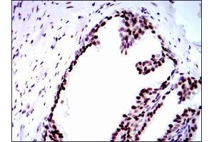 Immunohistochemical analysis of paraffin-embedded prostate tissues using RPA1 mouse mAb with DAB staining.